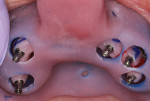 Fig 16. Individual inlay resin jigs are fabricated by the dental laboratory to ensure a passive fit of the final framework.