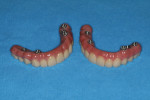 Fig 24. The PMMA transitional appliance and the final zirconia appliance are compared side-by-side.