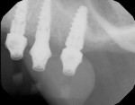 Fig 26. Digital periapical radiographs are taken of the multiunit abutments.