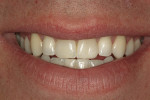 Figure 2  Fracture of the central incisor conservatively restored with composite restorative material (Empress Direct; Ivoclar Vivadent).