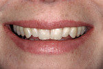 Figure 3  The patient was unhappy with the appearance of her diminutive maxillary lateral incisors.