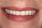 Figure 4  Composite was used to add bulk and contour to diminutive lateral incisors without any preparation (4 Seasons<sup>®</sup>; Ivoclar Vivadent).