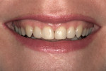 Figure 5  Composite bonding of teeth Nos. 7 to 10 completed by the author in 1988 needed replacement after 18 years.