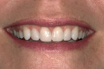 Figure 6  o-preparation bonding of teeth Nos. 6 to 11 after crown lengthening to allow proper proportionality of the maxillary anterior sextant (Empress Direct).