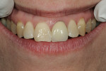 Figure 8  Upon lip retraction, it is clear that this PFM would not be appropriate for a patient with high lip dynamics.