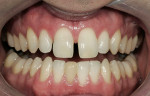 Figure 9  This patient sought a restorative solution that could eliminate the diastema and lighten teeth. (10.) Full-mouth bleaching, minimal preparation feldspathic veneers on teeth Nos. 6 to 11, and a leucite-reinforced restoration on tooth No. 25