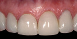 Figure 11  Porcelain veneers from 1989 presented for replacement in 1996.