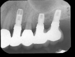Figure 4a  TISP on teeth Nos. 12 through 15. Tooth No. 13 is a natural tooth with a telescopic crown.