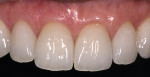 Figure 12  A combination of periodontal crown-lengthening procedures and restorative treatment with layered Empress veneers created a more natural appearance.