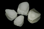 Figure 15  Prosthodontic units consisting of a zirconia core restoration for tooth No. 9 and conservative leucite-reinforced (Empress) veneers for teeth Nos. 7, 8, and 10 were fabricated.