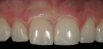Figure 4  Close-up of discolored tooth No. 8 after endodontic therapy