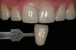 Figure 8   Tooth color after three sessions of internal bleaching.