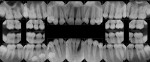 Pretreatment full-mouth series of radiographs showing localized severe bone loss associated with teeth Nos. 23 and 24 along with retained primary teeth on lower right side.