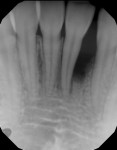 Pretreatment periapical radiograph of mandibular left central incisor (tooth No. 24), showing severe horizontal and vertical bone loss as well as open contact formation with tooth No. 23.