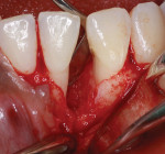 Surgical close-up view of a large osseous defect measuring 5 mm × 8 mm, which involved severe bone loss, diastema formation between the teeth, and missing buccal and lingual plate mass that resulted in the formation of two wall defects.