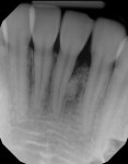Three-year posttreatment radiograph of tooth No. 24 exhibiting significant bone formation, regainment of bone previously lost in the horizontal and vertical dimensions, and significant improvement in closure of the diastema between the teeth.