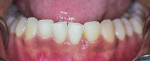 Three-year posttreatment closeup photograph of lower anterior teeth exhibiting improvement in tissue color, tone, and texture (compare with Figure 3) as well as closure of the open contact between teeth Nos. 23 and 24.