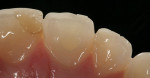Figure 10  The access opening was sealed with an opaque bleach, white shade of composite.