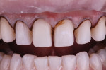 Retracted view of maxillary preparations showing final interproximal reduction after removal of decalcified enamel.