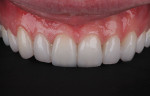 Postoperative retracted maxillary view demonstrating optimal gingival health.
