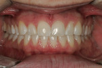 Figure 12  After external whitening with light-assisted in-office whitening.