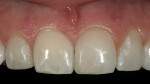 Figure 15  Finished composite-resin restorations on teeth Nos. 7, 8, and 9.