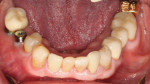Fig 3. Views of the mandibular arch indicate that the lower anterior teeth have been repaired with composites and crowns due to previous caries and wear.
