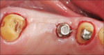 Figure 5  Intraoral view of four-unit TISP (teeth Nos. 2 through 5); implant is acting as pier abutment No. 4. Note retentive boxes placed on tooth abutment No. 2.