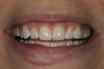 Figure 16  The final postoperative smile