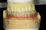 Fig 8. The upper arch is considered in the design of the lower immediate complete denture, which, when used, increases the patient’s occlusal vertical dimension.