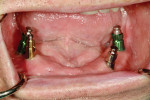 Fig 9. Implant impression copings are made with a closed tray due to lack of access. Note the depths and angulations of the two different implant systems.
