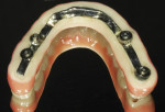 Fig 13. The fixed lower prosthesis and titanium substructure are made with nano-hybrid composite. The two parts are milled separately and bonded, and the gingival area is covered with composite before the final product is polished and glazed for delivery.