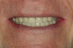 Fig 18. With the prostheses delivered, note the closure of the diastema between teeth Nos. 8 and 9, which was facilitated by addressing occlusion.