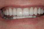Figure 5  Actual photograph of completed treatment. Courtesy of Envision A Smile.