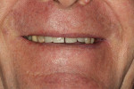 Fig 5. Initial full smile; note diastema between teeth Nos. 8 and 9.