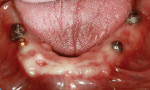 Fig 6. Mandibular arch with healing abutments placed on implants and a Locator attachment placed on the implant in the No. 29 position. Note the lack of salivary flow.