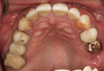 Fig 3. Initial maxillary arch.