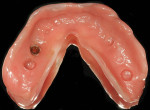 Fig 7. Ventral surface of the mandibular ICD with a soft reline and Locator attachment that was “picked up” directly.