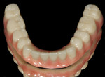 Fig 9. Nanohybrid fixed mandibular prosthesis.