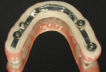 Fig 10. Titanium substructure with nanohybrid fixed mandibular prosthesis.