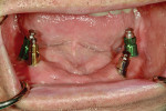 Fig 8. Implant impression copings; a closed-tray impression was used due to limited access. Note the various depths and angulations of the two different implant systems.
