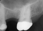 Fig 1. The No. 14 site approximately 26 months after extraction and socket grafting, radiograph.