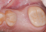 Fig 2. The No. 14 site approximately 26 months after extraction and socket grafting, occlusal view.