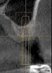 Fig 3. The No. 14 site approximately 26 months after extraction and socket grafting, CBCT.