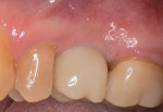 Fig 9. At 5 months post-implant-surgery, the completed crown was surrounded with healthy mucosa, free of inflammation.