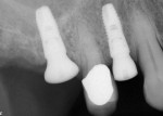 Fig 15. Radiograph taken at time of extraction of teeth Nos. 2 and 3 and implant placement at sites Nos. 3 and 5.