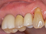 Fig 16. Final screw-retained crowns on Nos. 3 and 5.