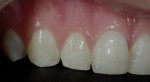 Figure 4  Preoperative view of teeth Nos. 5 through 12 needing restoration.