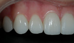 Figure 5  After view of feldspathic porcelain veneers on teeth Nos. 5 through 12. Note the influence of the natural teeth in Figure 6, which were used as an approximate blueprint.