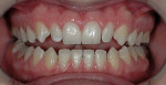 Figure 7  Preoperative view teeth Nos. 5 through 12.